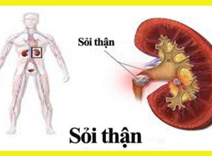 bệnh sỏi thận có triệu chứng gì? 10 triệu chứng để nhận biết bị sỏi thận